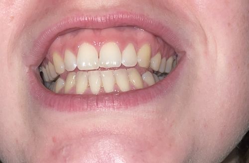 Customer photo review of PAP+ Complete Set