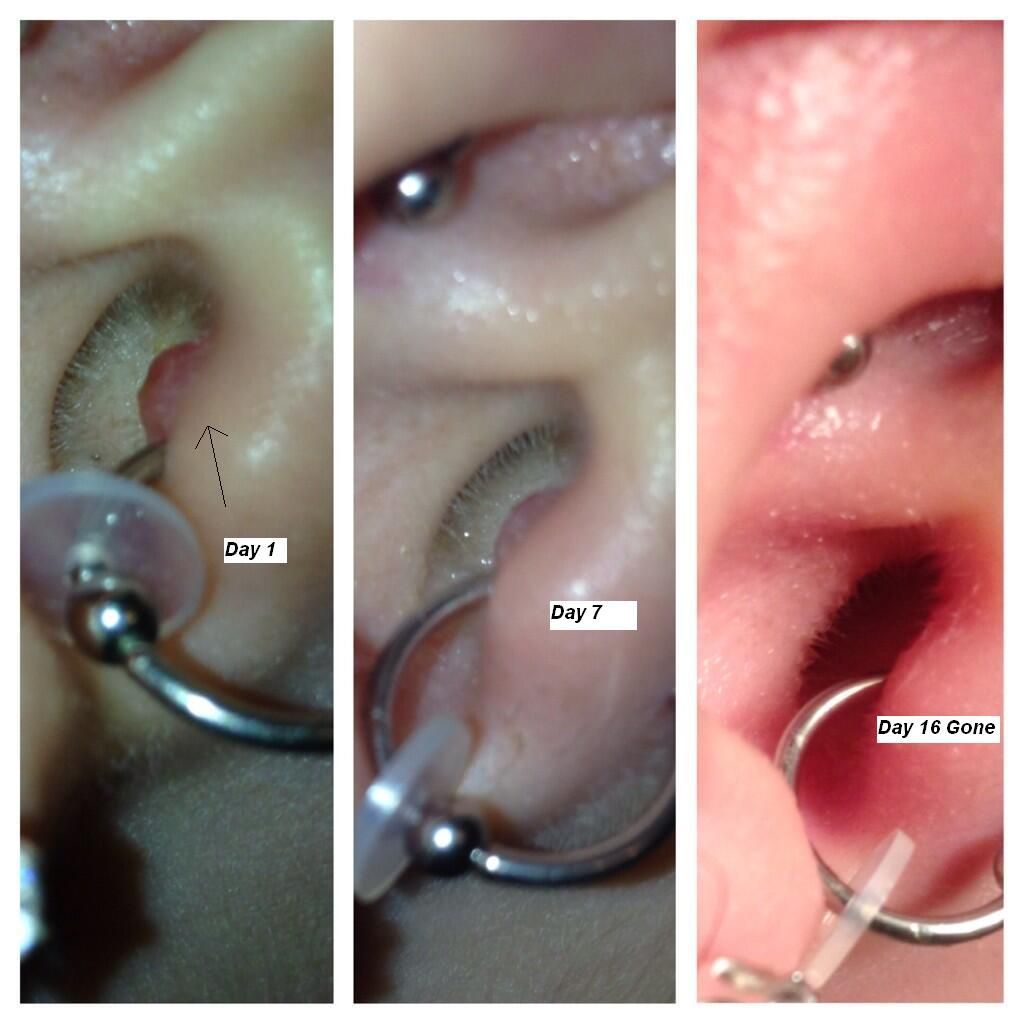 Customer photo review of Piercing Aftercare Spray - Soothes & Cleanses All Piercing Types   - 4oz