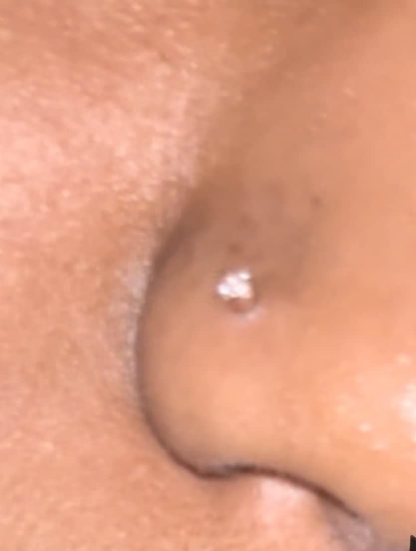 Customer photo review of Piercing Aftercare Spray - Soothes & Cleanses All Piercing Types   - 4oz