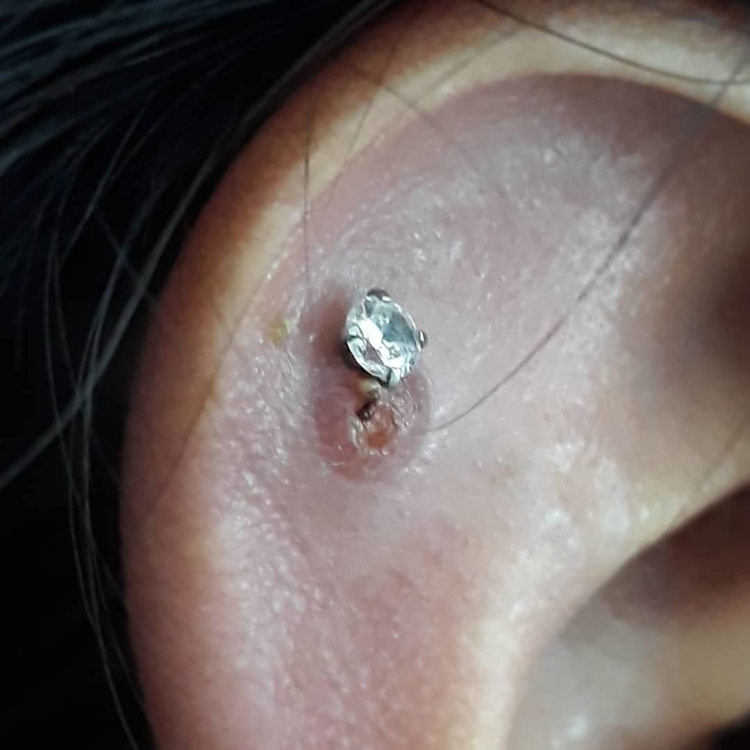 Customer photo review of Piercing Aftercare Spray - Soothes & Cleanses All Piercing Types   - 4oz