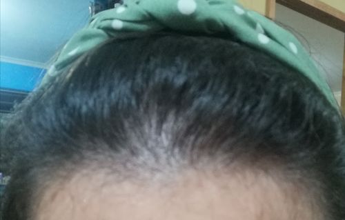 Customer photo review of PACK SHAMPOO ANTICAIDA  + ACONDICIONADOR 300 ML