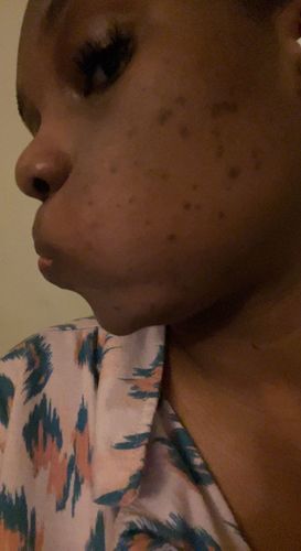 Customer photo review of BERRI-CLEAR+ 5 BERRY SUPERFRUIT SERUM