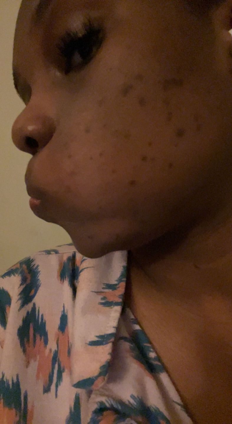 Customer photo review of BERRI-CLEAR+ 5 BERRY SUPERFRUIT SERUM