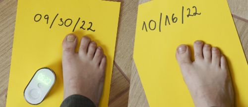 Customer photo review of Onychom - Antifungal Laser Device