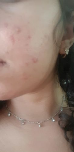 Customer photo review of ג'ל טיפולי לניקוי פנים לעור שמן הנוטה לפצעונים | AC - CLEAR FACE CLEANSER