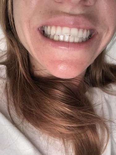 Customer photo review of SleepObrace™