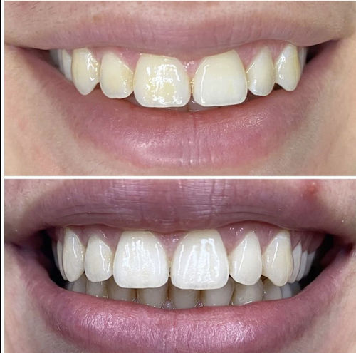 Customer photo review of Teeth Whitening Kit