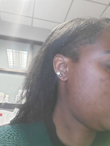 Customer photo review of BERRI-CLEAR+ 5 BERRY SUPERFRUIT SERUM