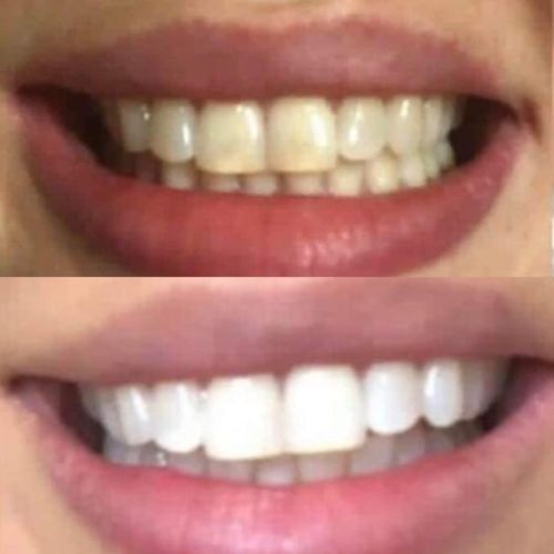 Customer photo review of Teeth Whitening Strips