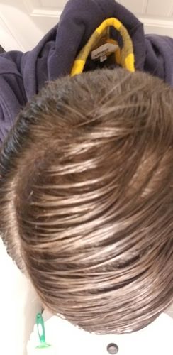 Customer photo review of 12.5% Minoxidil Extra Strength Topical Solution USP for Men.