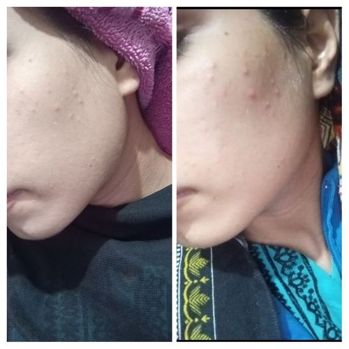 Customer photo review of Tea Tree Anti Acne Face Wash – Prevents Acne Eruptions, Removes Excess Oil, Reduces Blackheads & Whiteheads