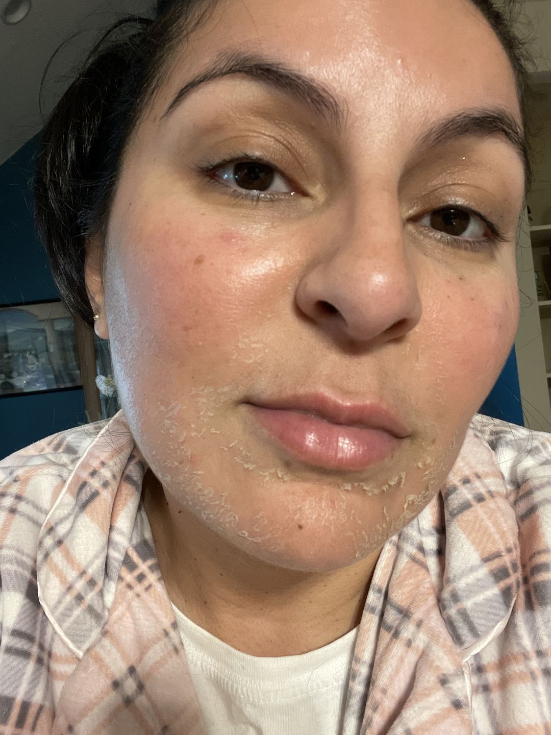 Customer photo review of 14% Jessner Skin Peel 🌿🍃🌱 Everything you need to do a skin peel! 🤩