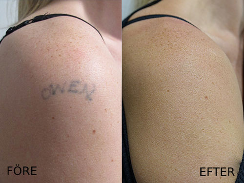 Customer photo review of QuickErase™ Snabb & Smärtfri Tatuerings Borttagnings Kräm