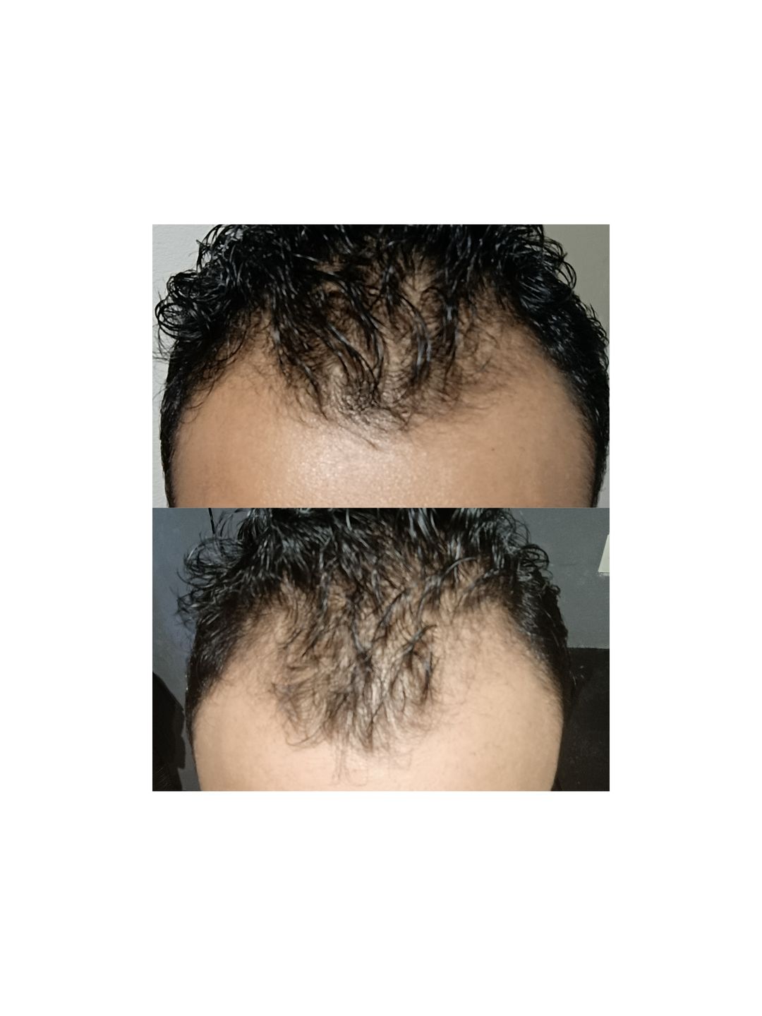 Customer photo review of Kit Adiós Alopecia