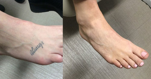 Customer photo review of QuickErase™ Snabb & Smärtfri Tatuerings Borttagnings Kräm