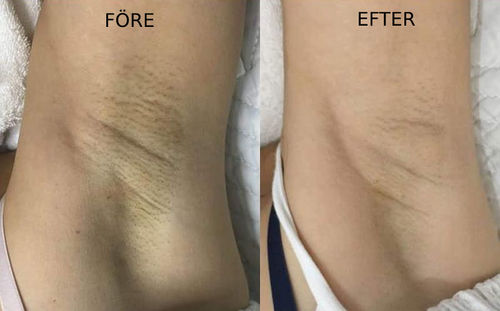 Customer photo review of InstaVit™ 3-dagars underarmsblekningskräm