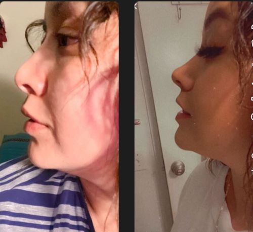 Customer photo review of NäsLyftare™ Näsavsmalningsklämma