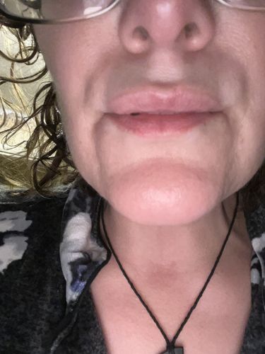 Customer photo review of LipFix: LipFlip