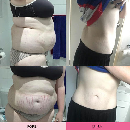Customer photo review of ÖronTerapi™ Akupressur Avsmalnande Örhängen