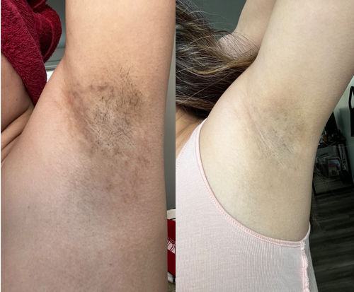 Customer photo review of InstaVit™ 3-dagars underarmsblekningskräm