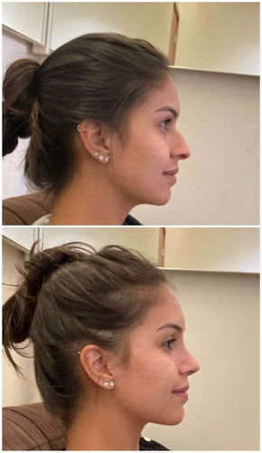 Customer photo review of NäsLyftare™ Näsavsmalningsklämma
