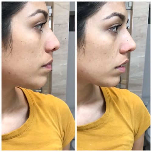 Customer photo review of NoseLifter™ Nose Shaper Tool
