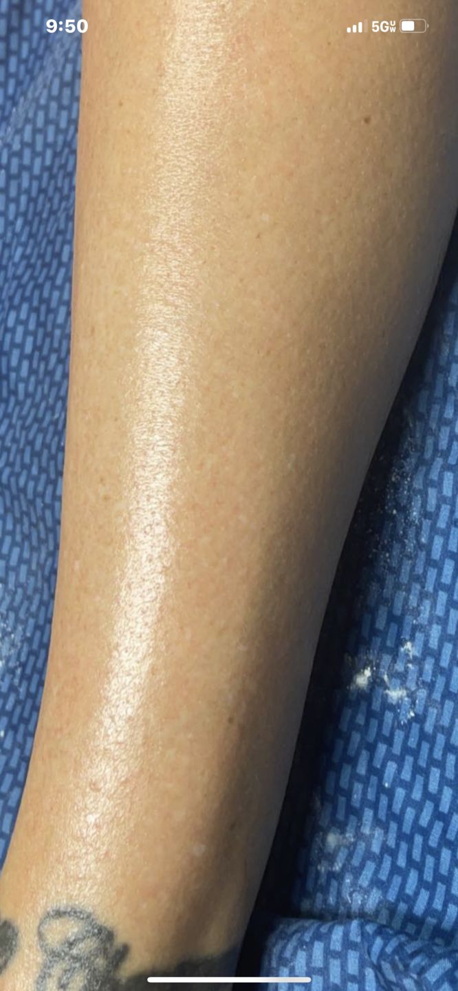 Customer photo review of Pro Series Hair Removal Wax