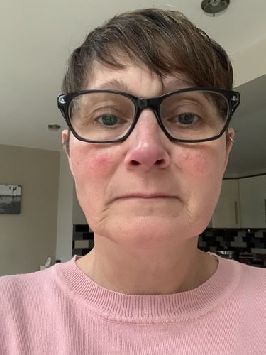 Customer photo review of Rosalique 3 in 1 Anti-Redness Miracle Formula SPF50