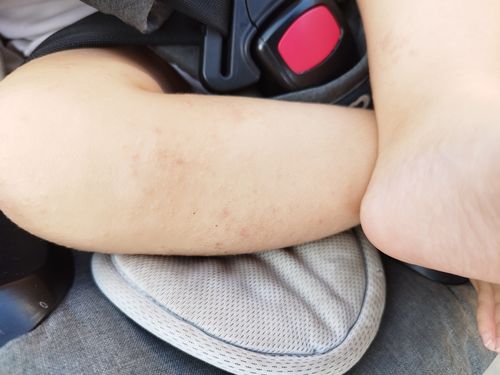 Customer photo review of ערכה טיפולית לעור אטופי ויבש | TOPIC SKIN KIT