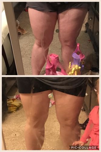 Customer photo review of LuxeSkin™ EMS Cellulitborttagning