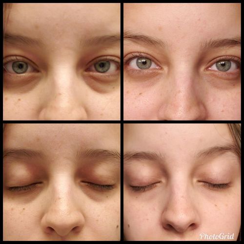 Customer photo review of RynkFri™ Ögonkräm Applikator & Massagepinne
