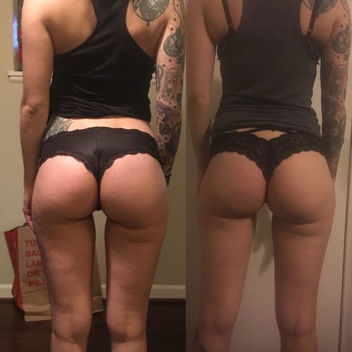 Customer photo review of LuxeSkin™ EMS Cellulitborttagning