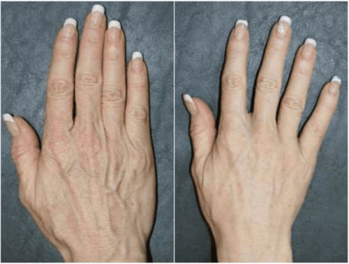 Customer photo review of HandLättnad™ Ven Borttagningsmassage för Händer
