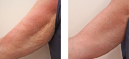 Customer photo review of CellulitMassage™ Celluliter Borttagning Massage