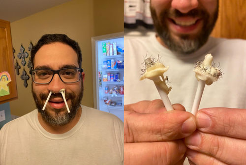 Customer photo review of NäsVård™ Näshår Vaxkit