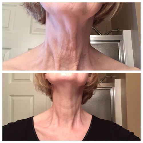 Customer photo review of SkinRevive™ Nacka Åtstramande Guldmask