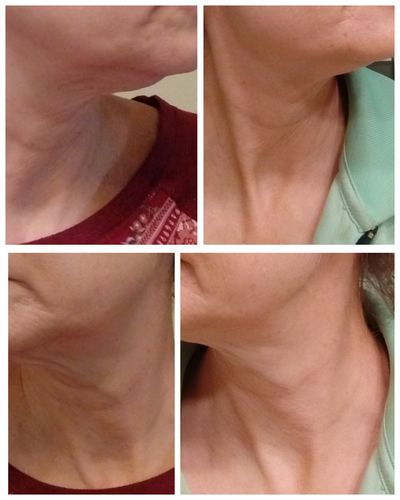 Customer photo review of SkinRevive™ Nacka Åtstramande Guldmask