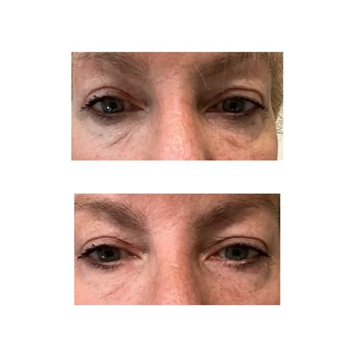 Customer photo review of SkinRevive™ Magisk Ögonkräm