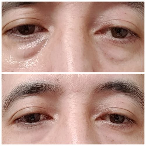 Customer photo review of SkinRevive™ Magisk Ögonkräm