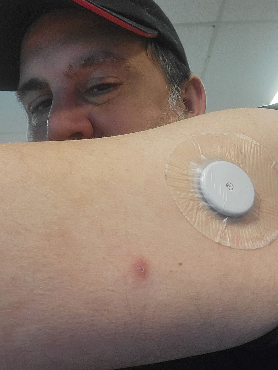 Customer photo review of Skin Grip Original - Freestyle Libre Adhesive Patches