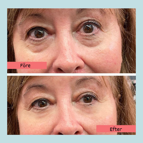 Customer photo review of SkinRevive™ Magisk Ögonkräm