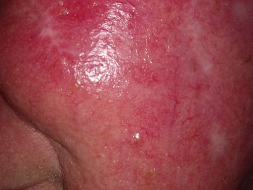 Customer photo review of Radiation Relief Cream – Unscented Burn Cream for Radiation Therapy