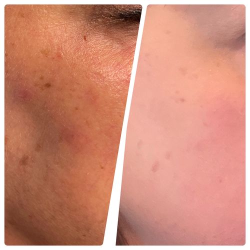 Customer photo review of MesoCapil Serum
