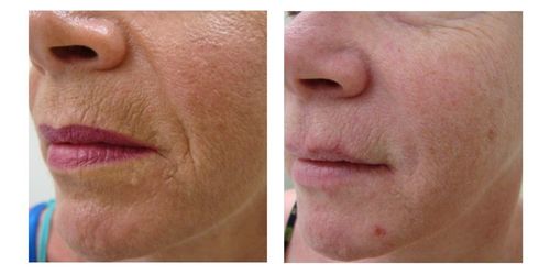 Customer photo review of Sarahbio - huile de pépins de figue de barbarie - 30 mL