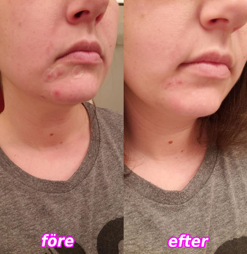 Customer photo review of HudPlåster™ Hudflik- & Akneplåster