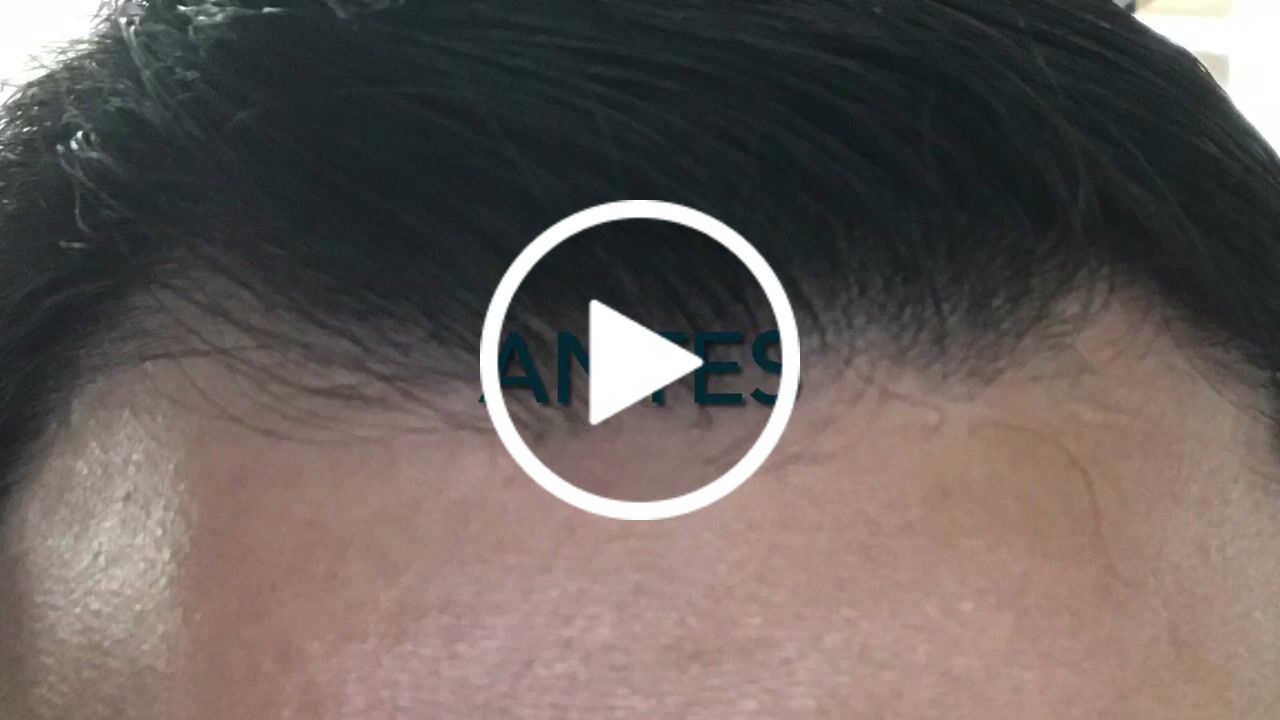 Customer video review of Kit Adiós Alopecia