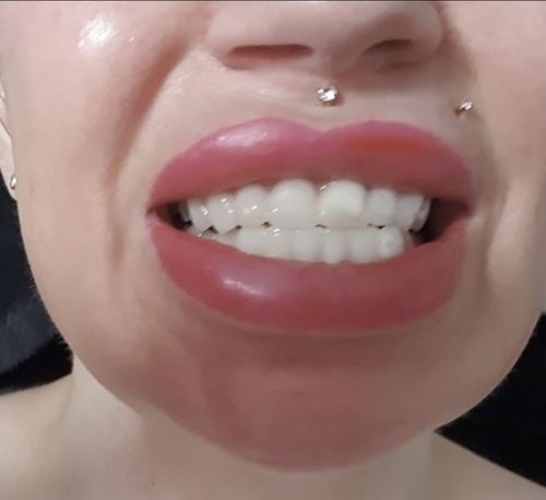 Customer photo review of Tooth-Veneer