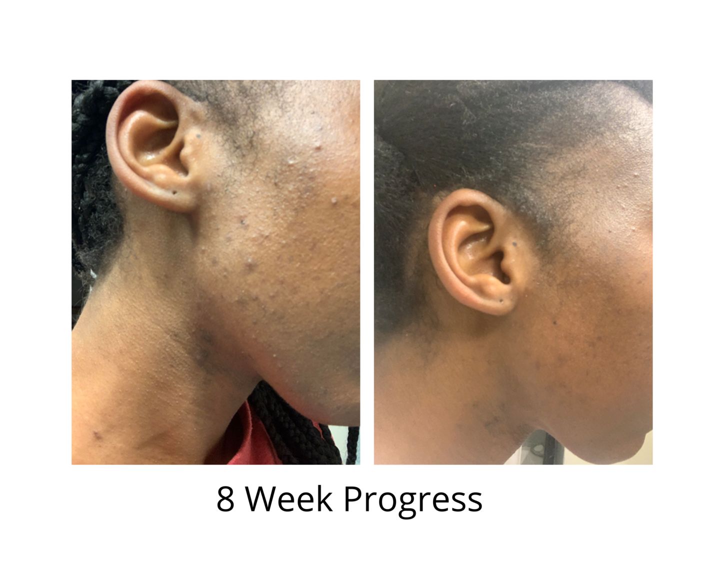 Customer photo review of Bolden Clear Skin Kit