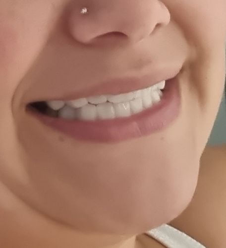 Customer photo review of Tooth-Veneer