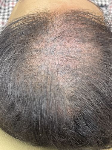 Customer photo review of MesoScalp Serum